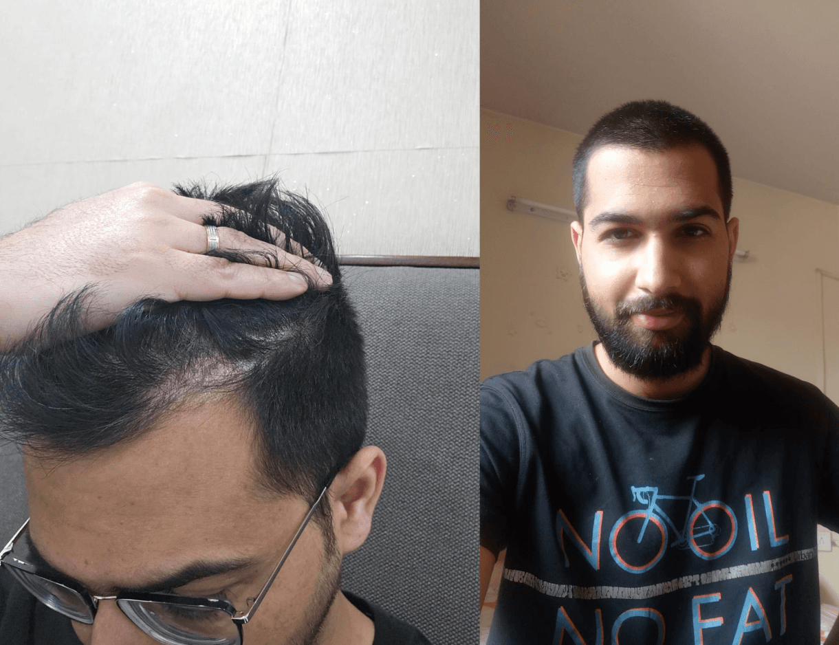 My experience with balding and what I learned from it